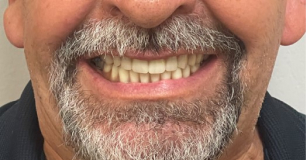 All-in-4 method case after the procedure