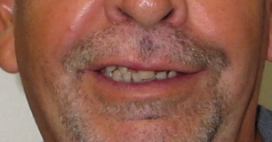 All-in-4 method case before the procedure