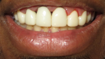 Case of crown implantation before procedure